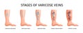 Stages Of Varicose Veins Royalty Free Stock Photo