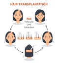 Stages of woman hair transplantation FUE Follicular Unit Extraction