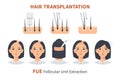 Stages of woman hair transplantation FUE Follicular Unit Extraction