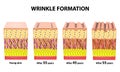 Stages of wrinkles at different ages. Anatomical structure of the skin. Elastin, Hyaluronic acid, Collagen. Infographics