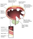 Staging of bladder cancer