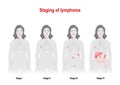 Staging of lymphoma. Woman silhouette with highlighted internal