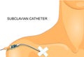 The staging of the subclavian catheter