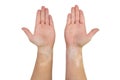 Stains from vitiligo disease on the inside of the hands and forearms of a young Caucasian woman, isolated on a white background w