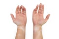 Stains from vitiligo disease on the inside of the hands and forearms of a young Caucasian woman, isolated on a white background w