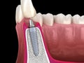 Standard abutment, dental implant and ceramic crown. Medically accurate tooth 3D illustration