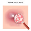 Staph infection. Acne Royalty Free Stock Photo