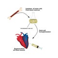 Stem cells from bone marrow is used to regenerate the cardiac muscle. Infographics. Vector illustration