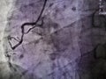 STEMI at right coronary artery