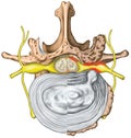 Stenosis, lumbar disk herniation VS good vertebra Royalty Free Stock Photo