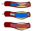 Stent