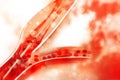 Stent angioplasty