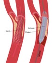 angioplasty, endovascular surgery. stent, balloon, medical illustration