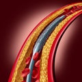Stent Coronary Placement Royalty Free Stock Photo