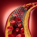 Stent Implant Concept Royalty Free Stock Photo