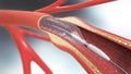 Stent implantation for supporting blood circulation into blood vessels Royalty Free Stock Photo