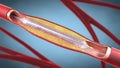 Stent implantation for supporting blood circulation into blood vessels - 3d illustration Royalty Free Stock Photo