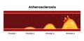 Step of Atherosclerosis graphic vector . fat stuck in the blood artery cholesterol