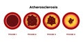Step of Atherosclerosis graphic vector . fat stuck in the blood artery cholesterol