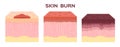 Step of burn . Normal to serious burn skin . vector and icon