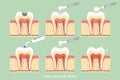 Step of caries to tooth amalgam filling with dental tools