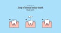 Step of dental onlay tooth Single tooth illustration vector on Royalty Free Stock Photo