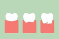 Step of gum disease