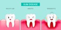 Step of gum disease. Healthy tooth and gingivitis.