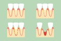 Step of periodontal disease or gingivitis of incisor tooth