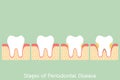 Step of periodontal disease / periodontitis / gingivitis / gum disease, dental problem Royalty Free Stock Photo