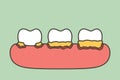Step of periodontitis or gum disease that is inflamed and has blood - dental cartoon vector flat style Royalty Free Stock Photo