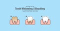 Step of single tooth Whitening-Bleaching and human gum illustration vector on blue background. Dental concept.