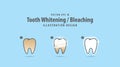 Step of single tooth Whitening-Bleaching illustration vector on Royalty Free Stock Photo