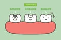 step of tooth amalgam filling by dental tools to protection decay tooth, before and after - teeth cartoon vector flat style Royalty Free Stock Photo