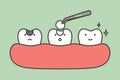 step of tooth amalgam filling by dental tools to protection decay tooth, before and after - teeth cartoon vector flat style Royalty Free Stock Photo