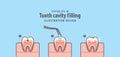 Step of tooth cavity filling cross-section structure inside toot