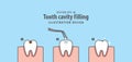 Step of tooth cavity filling illustration vector on blue background. Dental concept.