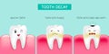 Step of tooth decay formation. Healthy tooth, forming dental plaque and finally caries and cavity.