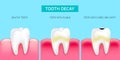 Step of tooth decay formation.