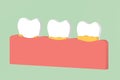 Step of tooth periodontal disease with dental plaque or tartar