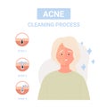 Steps for cleaning process against skin acne Royalty Free Stock Photo