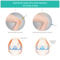 Steroid & Hyaluronic Acid Injection for Knee Joints. Illustration explain the steroid fluid and the hyaluronic acid fluid