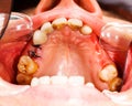 Stitches after Dental Extraction Royalty Free Stock Photo