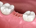 Stitches in gum after tooth extraction. 3D illustration of dental treatment Royalty Free Stock Photo