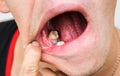 Stitches in the mouth on gums. Teeth implantation. Dental post preparation. Medical problem