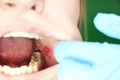 Painful ulcer and stomatitis on the mucous cheek of a girl. After the operation to remove the wisdom teeth. Stitches and