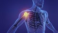 Animation of a painful shoulder