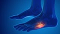 Broken foot bone pain medical concept