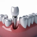 Dental implants surgery treatment, Dental crown 3D model close-up Royalty Free Stock Photo