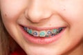 Stock photo of the metal braces